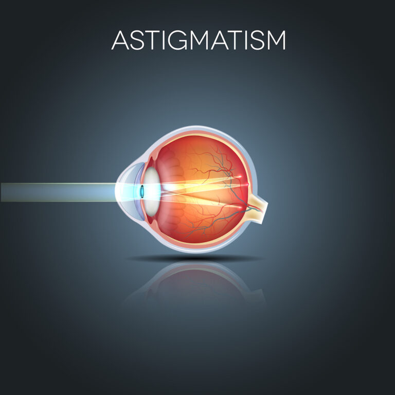 Cirurgia Refrativa corrige mesmo o astigmatismo Entenda tudo sobre a cirurgia a laser em Curitiba
