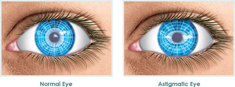 cirurgia refrativa a laser astigmastismo