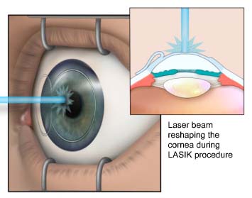 cirurgia refrativa laser curitiba