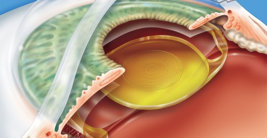 implante de lente intra ocular curitiba